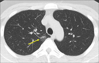 低線量肺がんCT検診